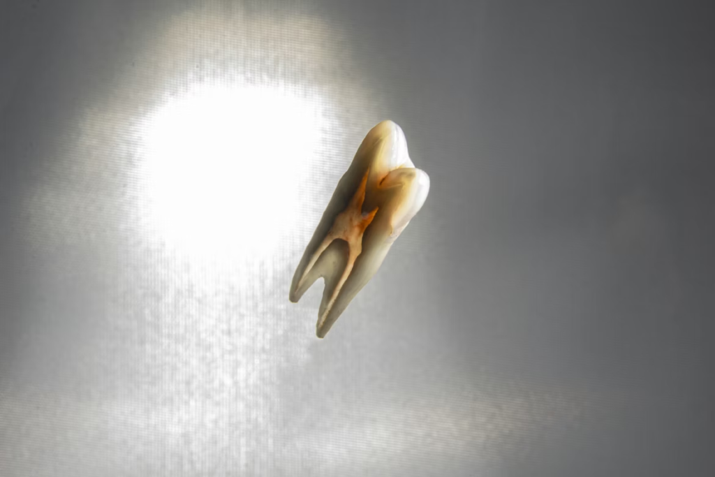 Dents de sagesse : douleur insupportable, que faire ?