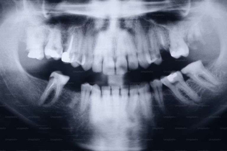 Dents de sagesse : douleur insupportable, que faire ?