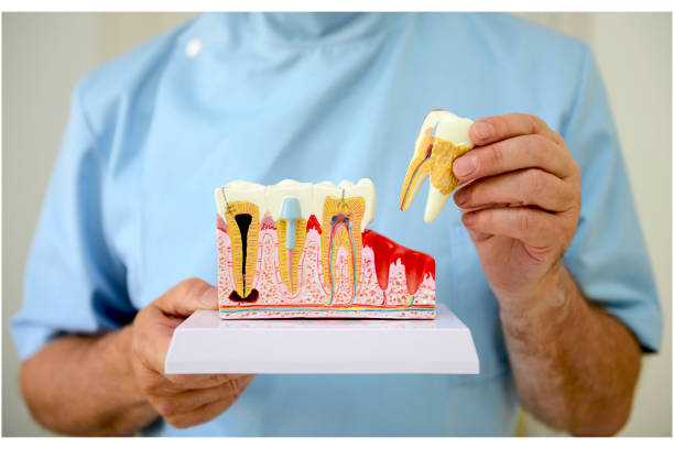 Peut-on arracher une dent infectée ou avec un abcès ?