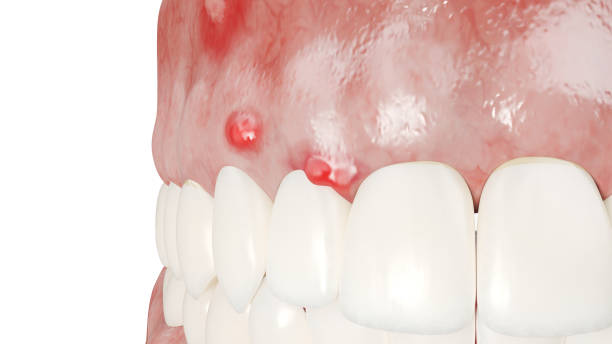 Peut-on arracher une dent infectée ou avec un abcès ?