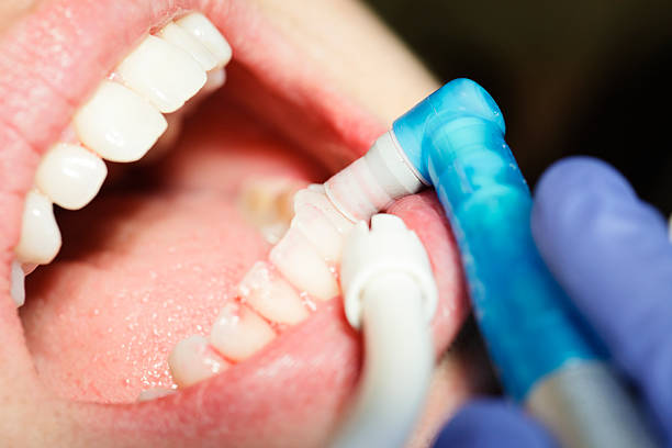 Eau oxygénée pour blanchir les dents : efficace ou dangereux ?