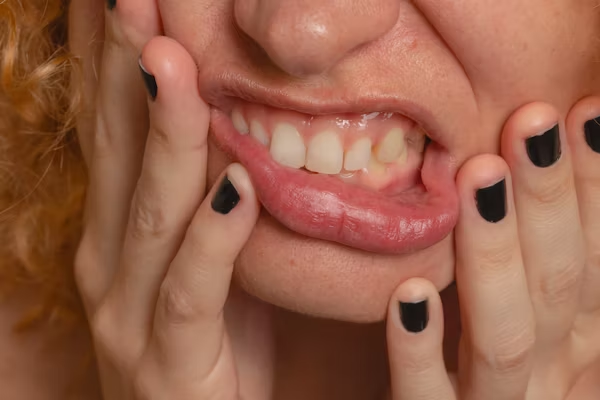 Dent cassée : que faire en attendant le dentiste ?