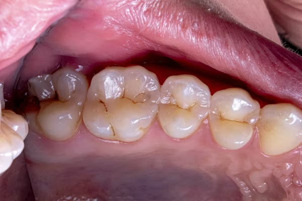 Dent cassée : que faire en attendant le dentiste ?