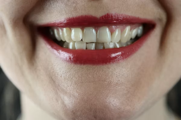 Taches blanches sur les dents : causes et traitements