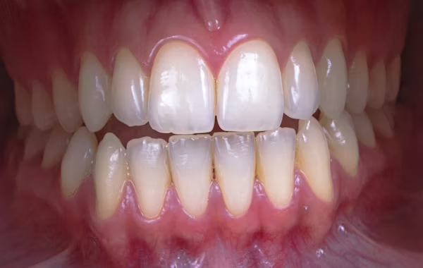 Taches blanches sur les dents : causes et traitements