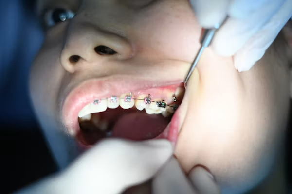 Infection d'une dent dévitalisée : signes, causes et traitement