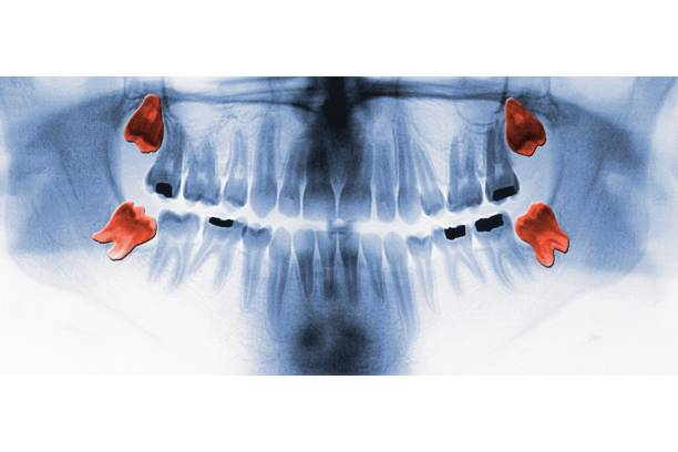 Bleu et gonflement après extraction des dents de sagesse : normal ou pas ?