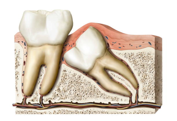 Bleu et gonflement après extraction des dents de sagesse : normal ou pas ?