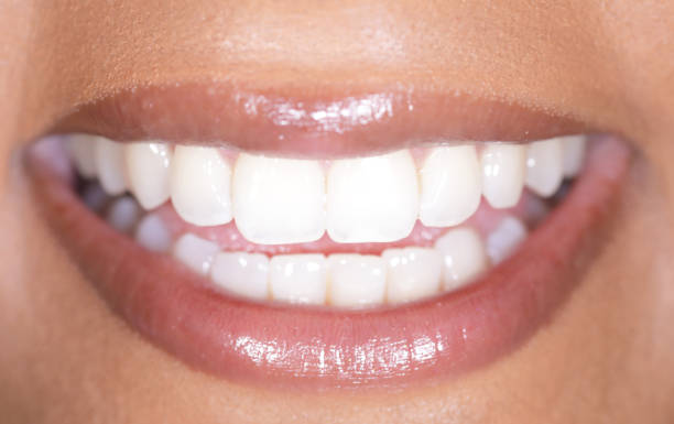 Stylo blanchiment des dents