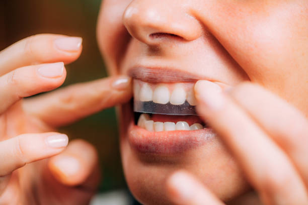 Stylo blanchiment des dents : le comparatif honnête avant d'acheter